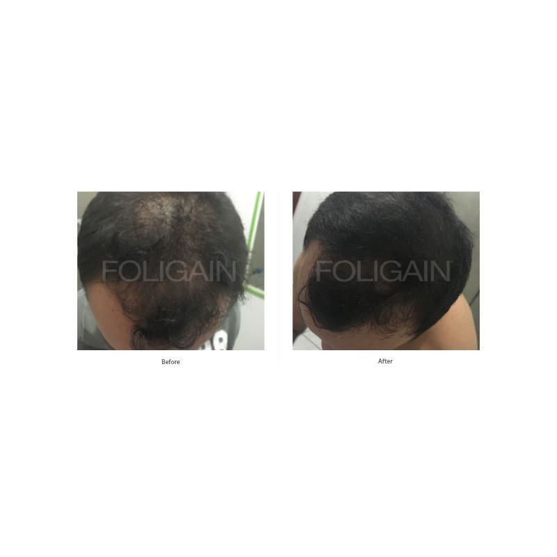 Ingrijire personala si Cosmetice - Sanatate si wellness - Suplimente alimentare - Vitamine si minerale - FOLIGAIN balsam pentru regenerarea parului pentru barbati 2% Trioxidil® (8oz) 236ml - Infinity.ro