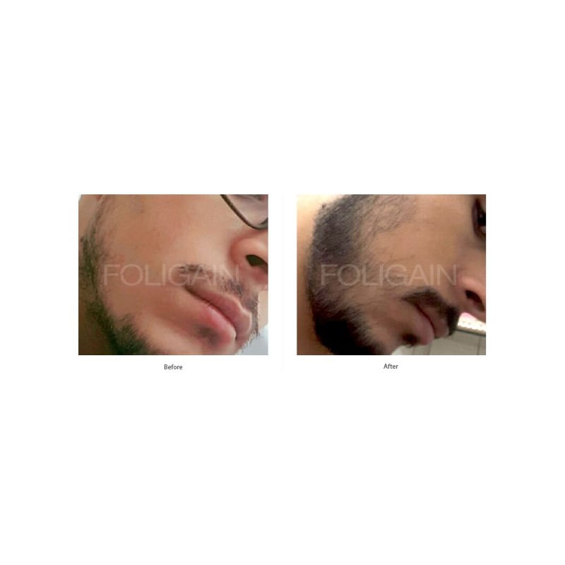 Ingrijire personala si Cosmetice - Sanatate si wellness - Suplimente alimentare - Vitamine si minerale - FOLIGAIN balsam pentru regenerarea parului pentru barbati 2% Trioxidil® (8oz) 236ml - Infinity.ro