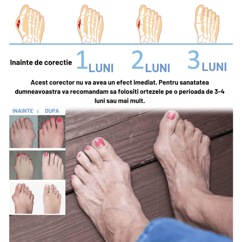 Ingrijire personala si Cosmetice - Sanatate si wellness - Aparate medicale - Suporturi ortopedice si orteze - Set 2 bucati orteze pentru corectarea monturilor, Gadgetry eliminarea - Infinity.ro