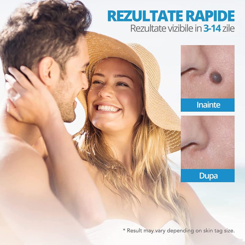 Ingrijire personala si Cosmetice - Aparate & accesorii ingrijire personala - Aparate cosmetice - Aparate intretinere si ingrijire corporala - Dispozitiv Indepartare Papiloame prin Ligaturare, LittleDomi, Skin Tag Removal Kit, pentru Fata, Gat, Corp, Dimensiuni - Infinity.ro