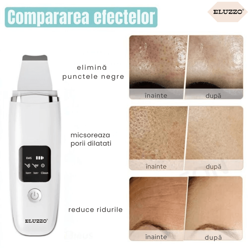 Ingrijire personala si Cosmetice - Aparate & accesorii ingrijire personala - Aparate cosmetice - Aparate intretinere si ingrijire corporala - Aparat de Curatare Faciala cu Ultrasunete ELUZZO®, Masaj, Scrubber pentru Ten, Indepartare Puncte Negre - Infinity.ro