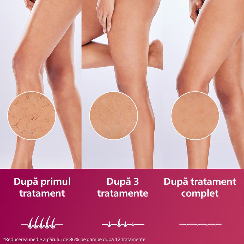 Ingrijire personala si Cosmetice - Aparate & accesorii ingrijire personala - Epilatoare si accesorii - Epilatoare - Epilator IPL Philips Lumea Seria 9900 BRI950/01, senzor SmartSkin, conectare la aplicatia cu functia Skin AI - Infinity.ro